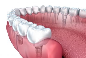 All On 4 Dental Implants