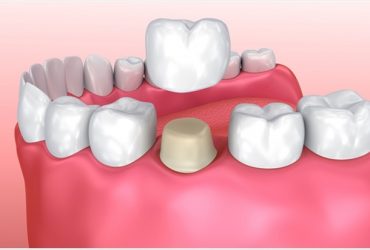 Dental Bridges