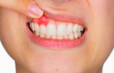Gingivitis Treatment