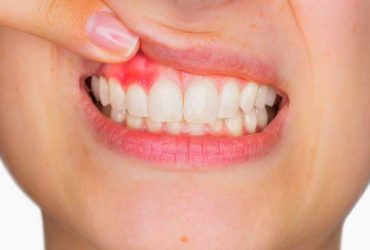 Gingivitis Treatment