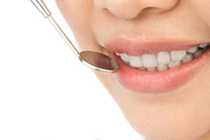 Veneers