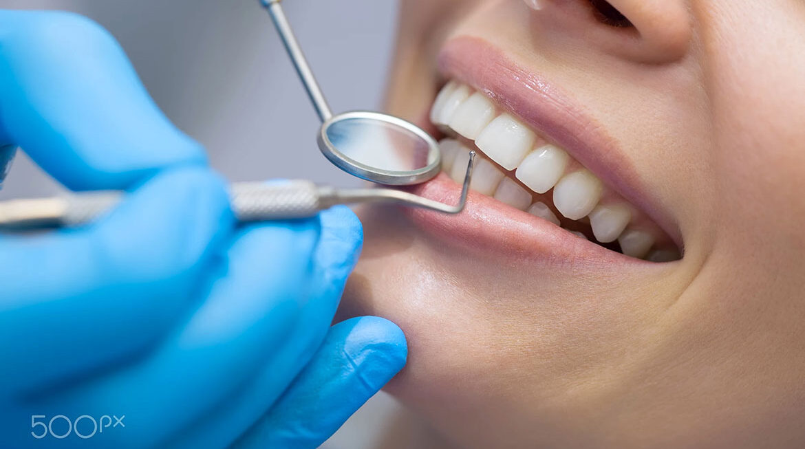 How Long Do Veneers Last And How to Care for Them