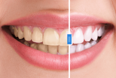 Cosmetic Smile Make overs