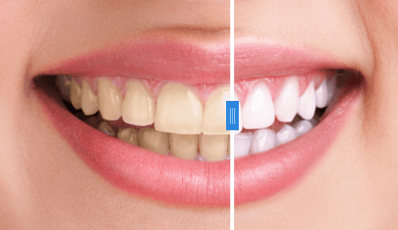 How Long Does Professional Teeth Bleaching Last?