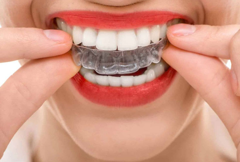 Removable Invisalign Langmore Dentist