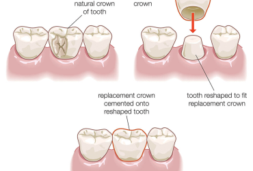 Dental Crowns