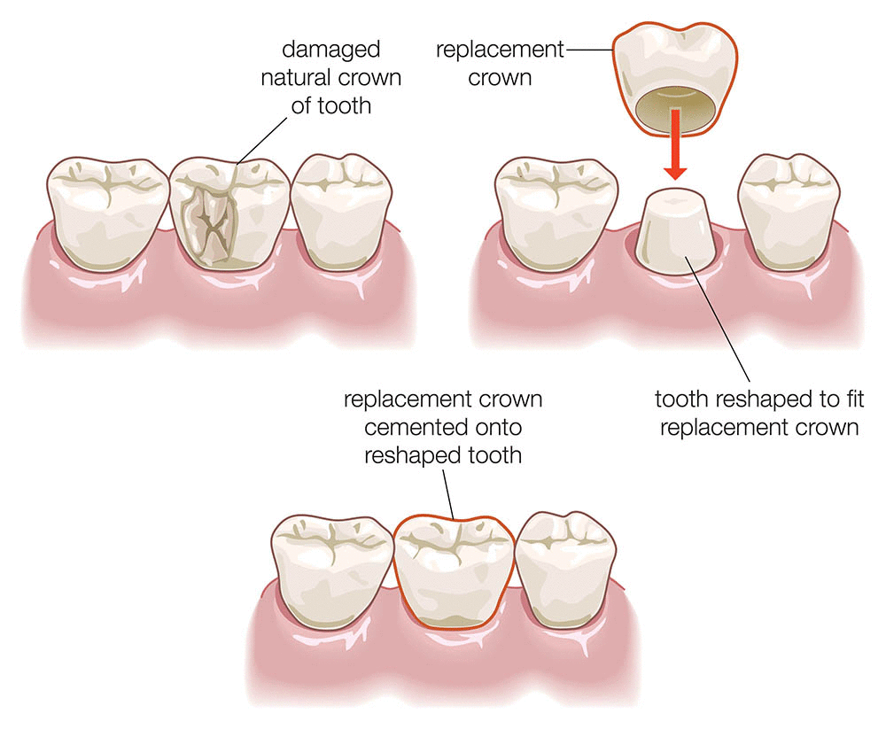 dental crowns berwick