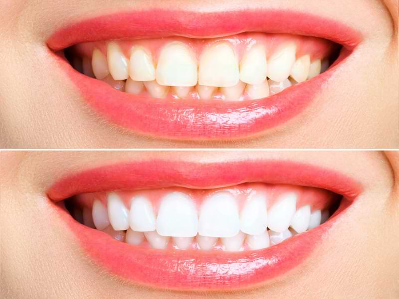 Before And After Teeth