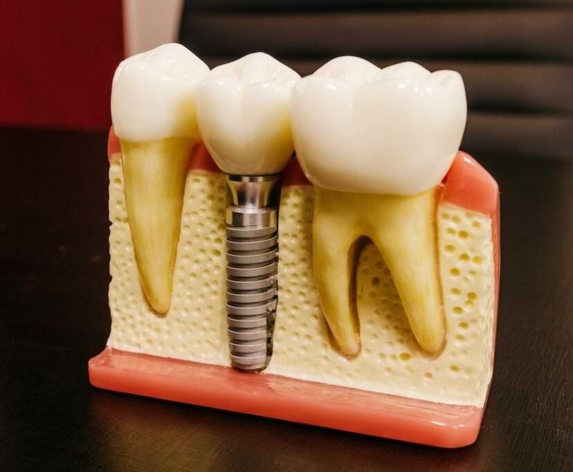 Root Canal Tooth